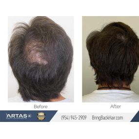 Recent work on a Crown hair restoration procedure! We’re very happy with how this turned out