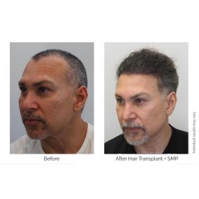 We had achieved amazing results with Felix after two hair transplant procedures and two SMP sessions.