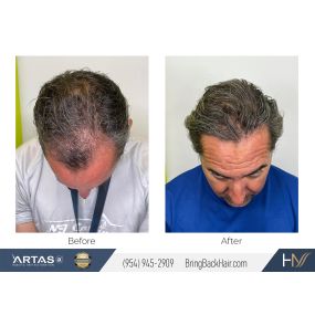 Check out these before and after results from a recent manual/robotic transplant procedure! It’s been about 13 months post-procedure, so the majority of results have set in for our patient here. Stay tuned for our patient testimonial video that we’ll be posting soon!