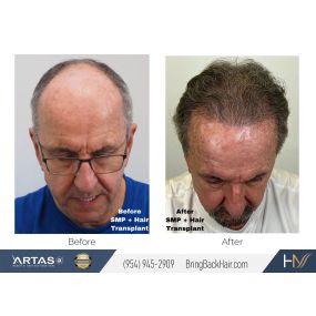 Just a couple of the many services we specialize in here at Hair By Dr. Max includes Hair Transplantation and SMP (scalp micropigmentation). In many cases, we suggest mixing different methods of hair restoration to achieve the best possible outcome. This patient of ours had done both a hair transplant (performed by Dr. Max himself) and SMP (performed by our SMP specialist @annaiegorova). We’re very happy to see such a drastic improvement in their results! For any questions you may have regarding