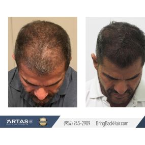 William came to Dr. Maxim Chumak at Maxim Medical Robotic Hair Transplant Clinic because he was looking for a permanent solution for hair loss