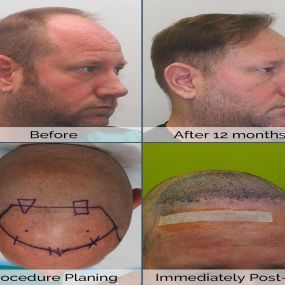 Whether hair loss is new to you, or you have struggled with it for years, we at Hair by Dr. Max have the answers and expertise to help!

To Schedule Your Free Consultation, Call Us At:
954-945-2909
Or Visit Our Website At:
https://bringbackhair.com/