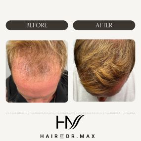 Check out this patient’s amazing before and after result! Our patient here is a 26 year old male who had 1674 grafts transplanted to their frontal hairline. This is about a year post-transplant. The outcome speaks for itself! Check out our website Bringbackhair.com to view our many more B/A results! #hairtransplant #hairrestoration #explorepage #hairlosstreatment