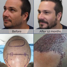 See the step by step process of Pedro’s hair restoration procedure using ARTAS Robotics. Make your dreams come true and achieve these similar outcomes with ARTAS robotic technology!