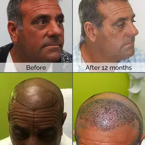 Using ARTAS robotic technology, Dr. Chumak helped restore Dominic's hair to its full vitality.