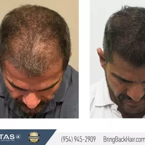 William came to Dr. Maxim Chumak at Maxim Medical Robotic Hair Transplant Clinic because he was looking for a permanent solution for hair loss