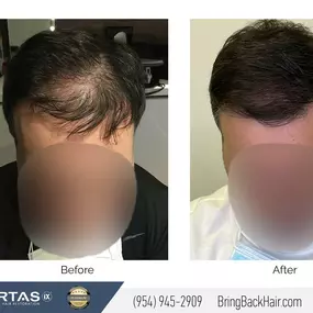 Hair By Dr. Max, Restoration Center
This patient’s amazing results were derived from two Scalp Micropigmentation (SMP) sessions with us here at Hair By Dr. Max. It’s clear to see a major advantage of this non-surgical method is that the results are immediate! No waiting time whatsoever! We are very proud of the results with this patient!
What makes our hair transplant process unique is the fact that Dr. Max is the only doctor who personally performs your transplant, including harvesting and impl