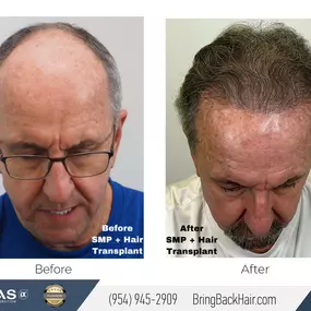 Just a couple of the many services we specialize in here at Hair By Dr. Max includes Hair Transplantation and SMP (scalp micropigmentation). In many cases, we suggest mixing different methods of hair restoration to achieve the best possible outcome. This patient of ours had done both a hair transplant (performed by Dr. Max himself) and SMP (performed by our SMP specialist @annaiegorova). We’re very happy to see such a drastic improvement in their results! For any questions you may have regarding