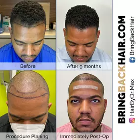 Here’s another great before and after result for a patient of ours. As you can see, we created a custom hairline restoration plan for Omar.