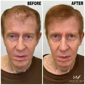 We had a patient of ours come in today for his 6 month post-transplant checkup and we couldn’t be more content with the results so far! Stay tuned for an upcoming testimonial with Roger!
Bringbackhair.com | 954-945-2909