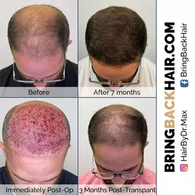 Whether hair loss is new to you, or you have struggled with it for years, we at Hair By Dr. Max, Restoration Center have the answers and expertise to help!

To schedule your free consultation, call us at: 954-945-2909
Or visit our website at:
Bringbackhair.com