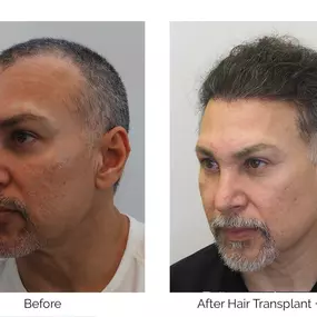 We had achieved amazing results with Felix after two hair transplant procedures and two SMP sessions.