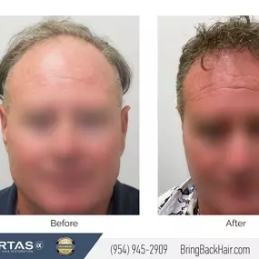 Hair By Dr. Max, Restoration Center

These are the before and after results for one of our hair transplant patients after one year since their procedure! Whether hair loss is new to you, or you have struggled with it for years, we at Hair By Dr. Max have the answers and expertise to help. 

What makes our clinic unique is not only our skilled staff, but the fact that Dr. Max is the only surgeon who personally performs each and every procedure, including harvesting and implantation.  Leading by e