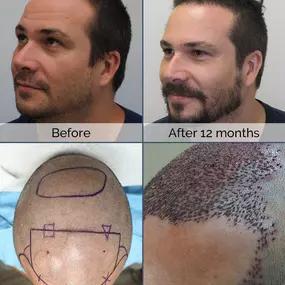 See the step by step process of Pedro’s hair restoration procedure using ARTAS Robotics. Make your dreams come true and achieve these similar outcomes with ARTAS robotic technology!