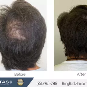 Recent work on a Crown hair restoration procedure! We’re very happy with how this turned out