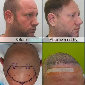 Whether hair loss is new to you, or you have struggled with it for years, we at Hair by Dr. Max have the answers and expertise to help!

To Schedule Your Free Consultation, Call Us At:
954-945-2909
Or Visit Our Website At:
https://bringbackhair.com/