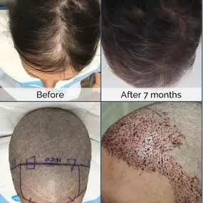 It’s time to invest in the new you!
ARTAS robotic technology delivers promising hair restoration in just a few months. Here are the results of one of our ARTAS patients who achieved their dream results after undergoing the procedure. 
Take the first step towards natural, permanent hair today! Give us a call for a free consultation: (833) MOR-HAIR
(833) 667-4247