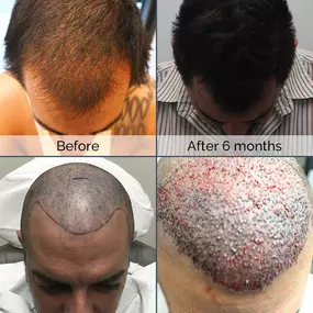 Using ARTAS robotic technology, Dr. Chumak helped restore Francesco’s hair to its full vitality. Want your hair back too? Visit our website to see just how at www.bringbackhair.com , along with other testimonials!