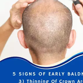 5 Early Signs You May Be Going Bald

3. Thinning Of Crown Area
Another common characteristic of Male Pattern Baldness is if you notice thinning in the crown area of your hair. Aside from your frontal hairline and temple area, the crown is a main result of MPB. In many cases this can occur even before thinning hair in front. Not all people go bald from their hairline. Some men experience what's called diffuse thinning. This is a type of hair loss that either affects the entire scalp or specific a