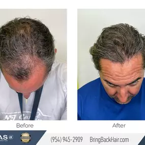 Check out these before and after results from a recent manual/robotic transplant procedure! It’s been about 13 months post-procedure, so the majority of results have set in for our patient here. Stay tuned for our patient testimonial video that we’ll be posting soon!