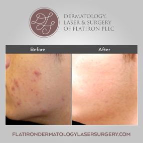 Laser dermatology can improve skin texture & reduce the signs of aging around the face, hands, & body. Laser skin resurfacing, laser hair removal, & laser vein treatment are available at Dermatology, Laser & Surgery of Flatiron PLLC to restore a radiant skin tone.