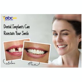 Dental Implants Before And After Image From Abc 123 Dental Of Keller