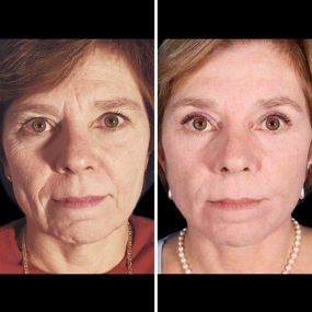 Facelift surgery is an operation designed to reduce the signs of aging and promote a refreshed, rejuvenated facial appearance. During a facelift, Dr. Marefat can counteract the effects of aging by lifting and repositioning the skin and tissues of the face to a more youthful position.