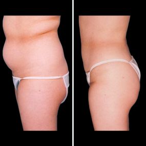 Liposuction is a popular cosmetic surgery procedure that can help recontour the body and remove stubborn pockets of fat that have not responded to diet or exercise. Because liposuction removes pockets of fat, Dr. Marefat is able to improve your body’s natural contours and establish more aesthetic proportions between different areas of the body.