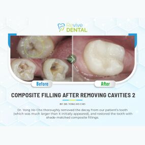 Revive Dental Lewisville | Composite Filling After Removing Cavities | Case Study