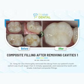 Revive Dental Lewisville | Composite Filling After Removing Cavities | Case Study