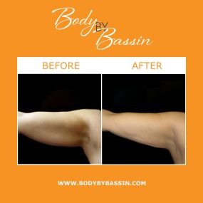 Multiple minimally invasive liposuction procedures are available at Body By Bassin, including BodyTite™ & Aqualipo®. BodyTite™ utilizes radio frequency energy to tighten loose or drooping skin & remove small amounts of unwanted fat. Aqualipo® is a water-jet liposuction technique that can gently flush away stubborn fat cells from the body using a concentrated stream of water. These liposuction alternatives can achieve substantial body sculpting results.