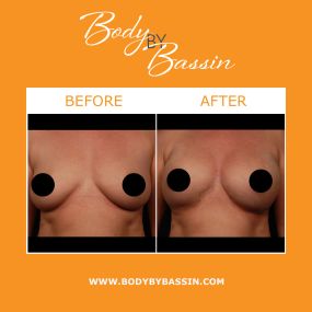 NaturalFill® breast enhancement uses the Aqualipo® liposuction process with fat transfer to provide long-lasting, natural-looking breast enhancements. NaturalFill® breast enhancement smooths irregularities, improves breast shape, and increases breast size.