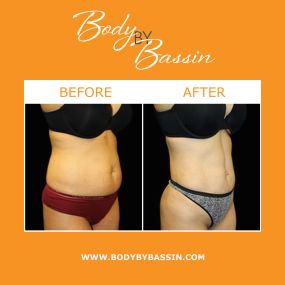 Liposuction in Orlando can enhance body contours and accentuate your natural musculature. Liposuction is a long-lasting procedure that can target the neck, breasts, chest, arms, abdomen, flanks, back, buttocks, thighs, and legs.