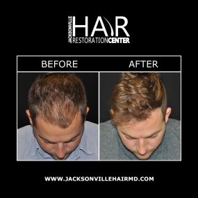 NeoGraft® hair restoration is an innovative “No Touch” hair transplant method that uses automated Follicular Unit Extraction (FUT) to remove hair follicles & transplant them to areas of thinning hair. NeoGraft® is minimally invasive & can achieve a fuller hairline without any stitches, incisions, or linear scarring. Our Jacksonville hair doctors perform NeoGraft® to achieve long-lasting hair restoration results.