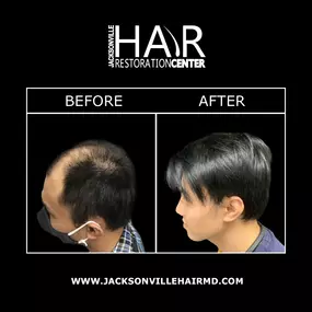 Jacksonville Hair Restoration Center can help restore hair for patients suffering from receding, balding, or thinning hair. Our doctors are trained in the most advanced techniques today, such as SmartGraft®, NeoGraft®, ARTAS®, and scalp micropigmentation. Contact us today to find the best hair restoration technique for you.