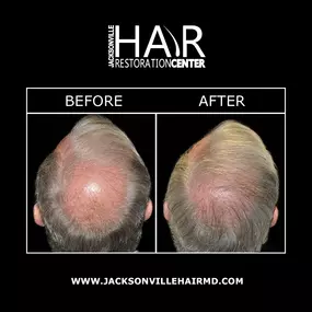 Jacksonville Hair Restoration offers PRP Progrowth Hair Therapy – a unique hair restoration formula that incorporates platelet rich plasma treatment & A-Cell therapy to encourage the growth of your natural hair follicles. Progrowth hair replacement is completely non-surgical & requires minimal downtime while providing long-lasting hair restoration results.