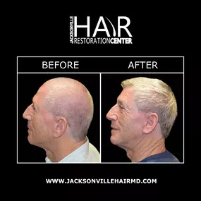 SmartGraft® is an innovative hair transplant procedure to regrow areas of thing hair using your own natural hair follicles with no incisions necessary. SmartGraft® utilizes the latest technology to ensure hair transplant results are the most successful.