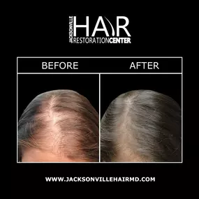 Jacksonville Hair Restoration Center offers stem cell hair restoration, an innovative procedure that uses your own body’s stem cells to encourage hair growth and healing. Stem cell hair restoration uses a mixture of stem cells and platelet rich plasma to repair and stimulate hair growth in existing hair follicles. This mixture can also activate existing stem cells to further restore thinning hair.