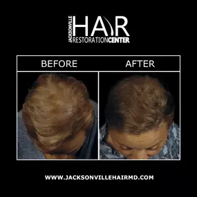 NeoGraft® in Jacksonville uses pneumatic pressure to harvest and implant follicles from and to the scalp, making the procedure “no touch”. NeoGraft® produces more volume and natural-looking results with a quicker recovery time.