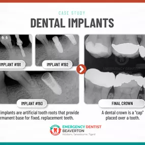 Sunrise Emergency Dentist of Beaverton - Hillsboro, Tanasbourne, Tigard | 14425 SW Allen Blvd #3 Beaverton, OR 97005 | Call: (503) 644-1127