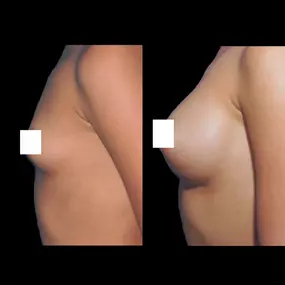 Breast augmentation in Virginia uses saline or silicone implants to enhance the shape, symmetry, and size of the breasts. Breast implants can help create larger breasts for women who have lost the fullness of their breasts or who have underdeveloped breasts.