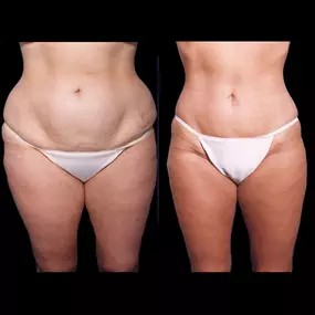 Liposuction is a plastic surgery procedure that can help remove unwanted fat deposits with minimal incisions. Lipo is ideal for patients looking to treat stubborn areas of fat that do not respond to exercise and diet.