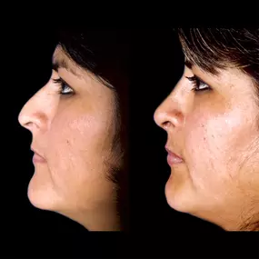 Rhinoplasty can recontour the nasal profile and create a nose that is better suited to your facial features. Nose surgery can reduce and enhance your nasal shape for a harmonious, natural-looking appearance. Additionally, functional rhinoplasty can help correct a deviated septum, nasal trauma, and other types of breathing problems.