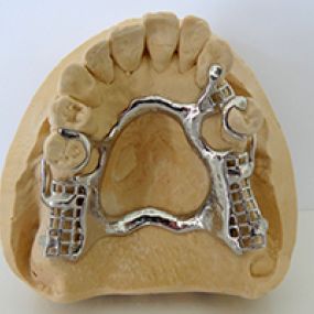 Frames en gedeeltelijke protheses