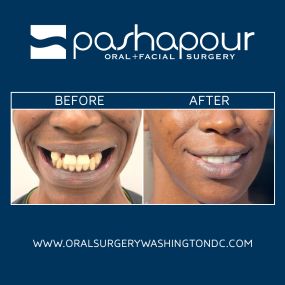 Full mouth restoration provides transformative results. Full mouth reconstruction utilizes multiple dental implants to replace all missing teeth on the upper and lower jaw. Patients can restore their smile with natural-looking dental implants and benefit from improved oral health.