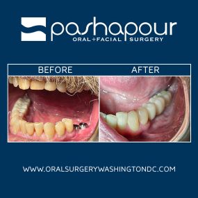 Dental implant surgery is a permanent solution to missing or chipped teeth. Unlike dentures or dental bridges, which can cause bone loss, dental implants are a more durable & natural-looking option. Dr. Pashapour can replace a single missing tooth or multiple teeth using dental implants.