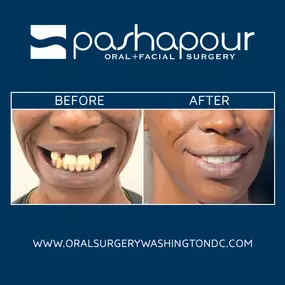 Full mouth restoration provides transformative results. Full mouth reconstruction utilizes multiple dental implants to replace all missing teeth on the upper and lower jaw. Patients can restore their smile with natural-looking dental implants and benefit from improved oral health.