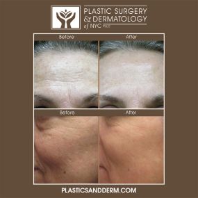 Laser dermatology can improve skin tone, texture, and elasticity. Non-invasive laser treatments, such as laser skin resurfacing are available to reduce the signs of aging, correct pigmentation issues, and to improve the appearance of scars, including acne scarring.