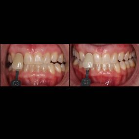 One session of Laser Smile Whitening!