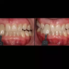 One session of Laser Smile Whitening!